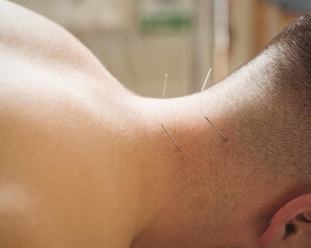 A person lying face down on a massage table with a therapist inserting a thin acupuncture needle into the back of their neck. The person's neck and upper back muscles are visible, and the therapist's hand is reaching across the person's back to stabilize the needle. The room appears to be dimly lit with soft lighting