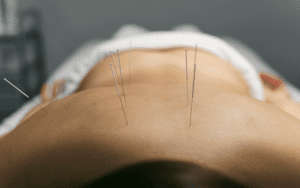 Acupuncture process for client that needle in the waist and back