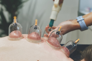 Professional Cupping Therapy in Toronto, FTA, Aurora Near Me